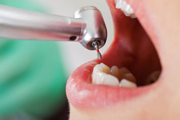 Best Emergency Tooth Extraction in Stanleytown, VA
